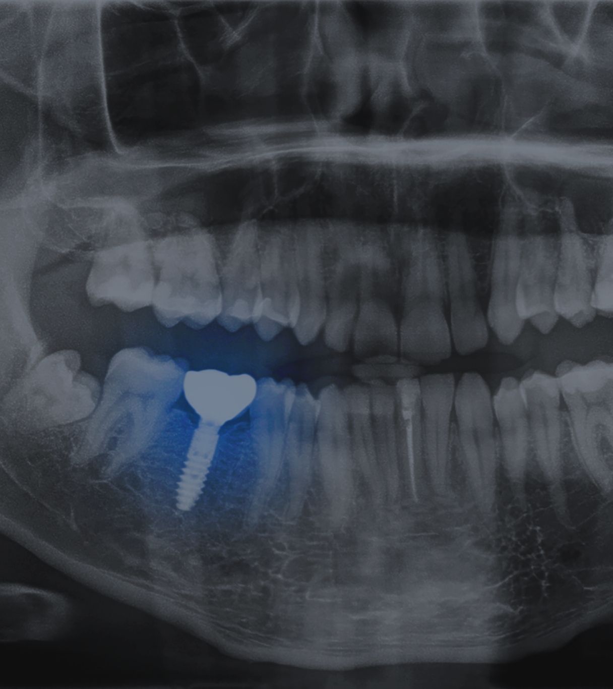 cuanto cuesta un implante dental