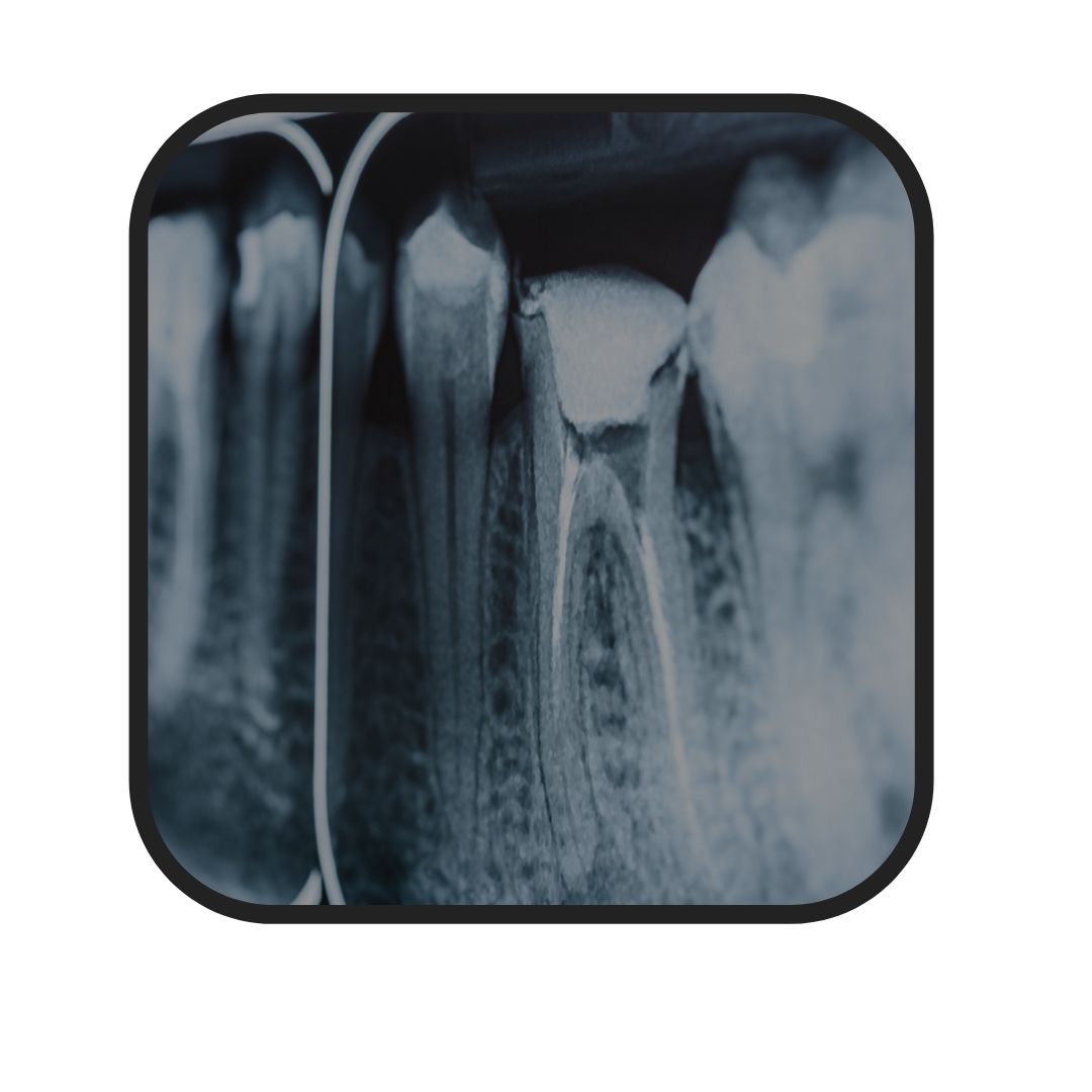 endodoncia