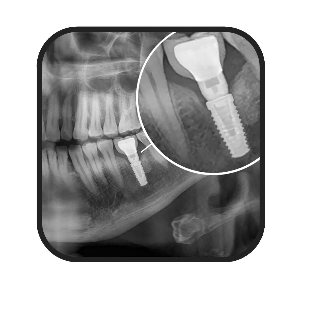 implantes dentales en alcoy
