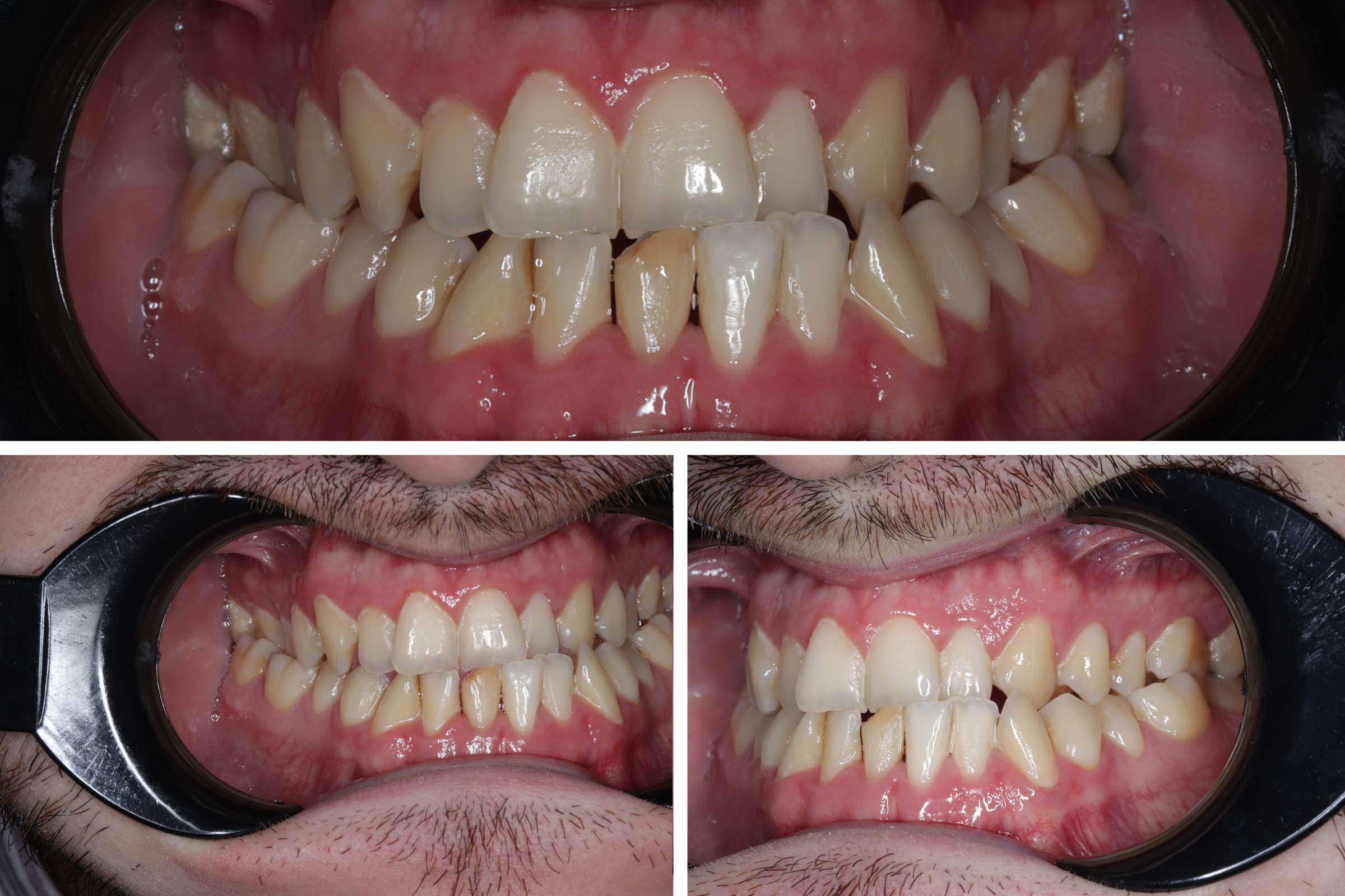 caso clínico de paciente con maloclusion dental de Odontostetic