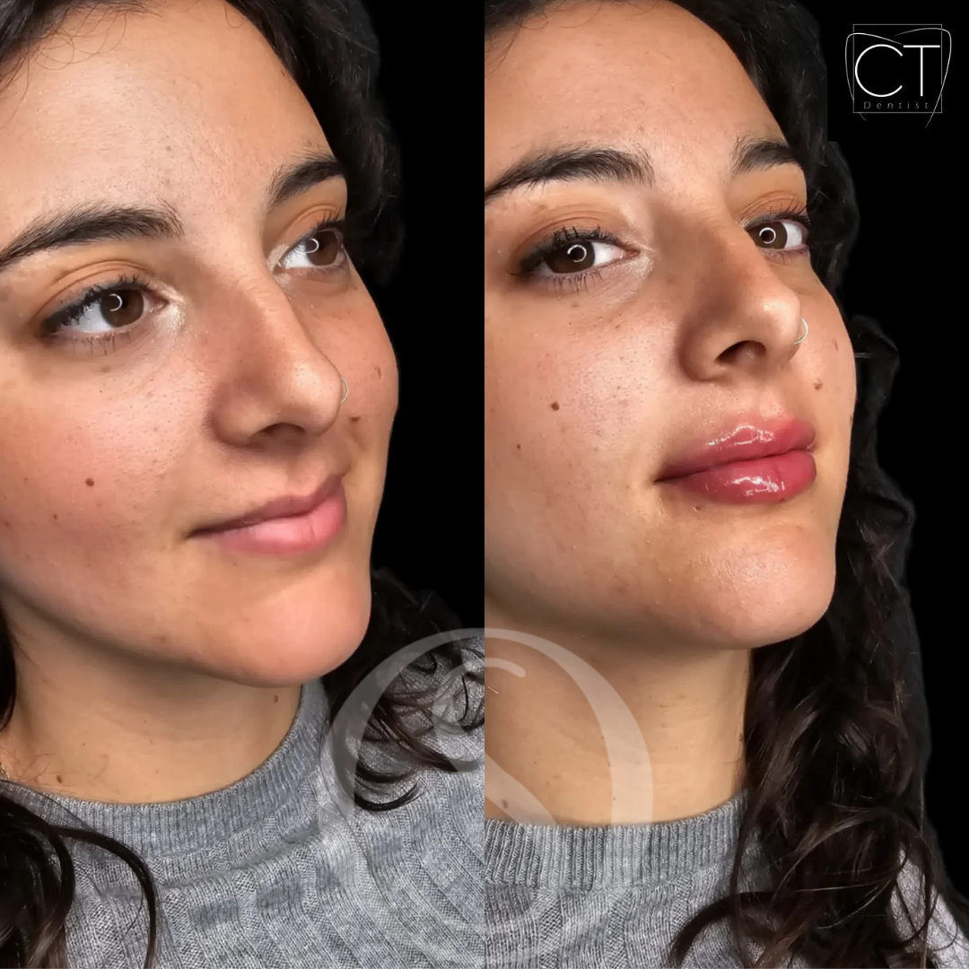 aumento de labios, caso clínico aumento de labios, caso clínico