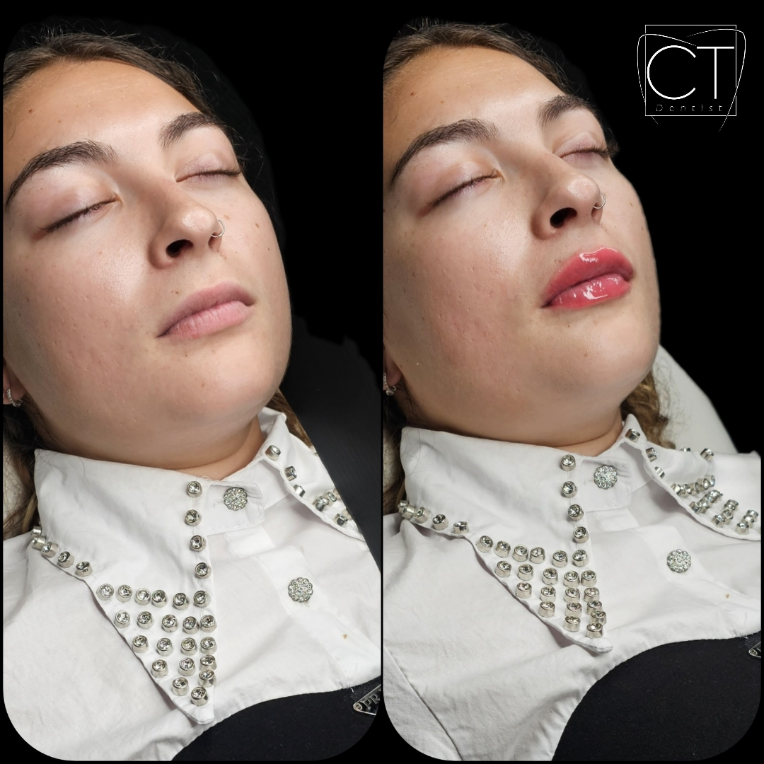 aumento_de_labios4