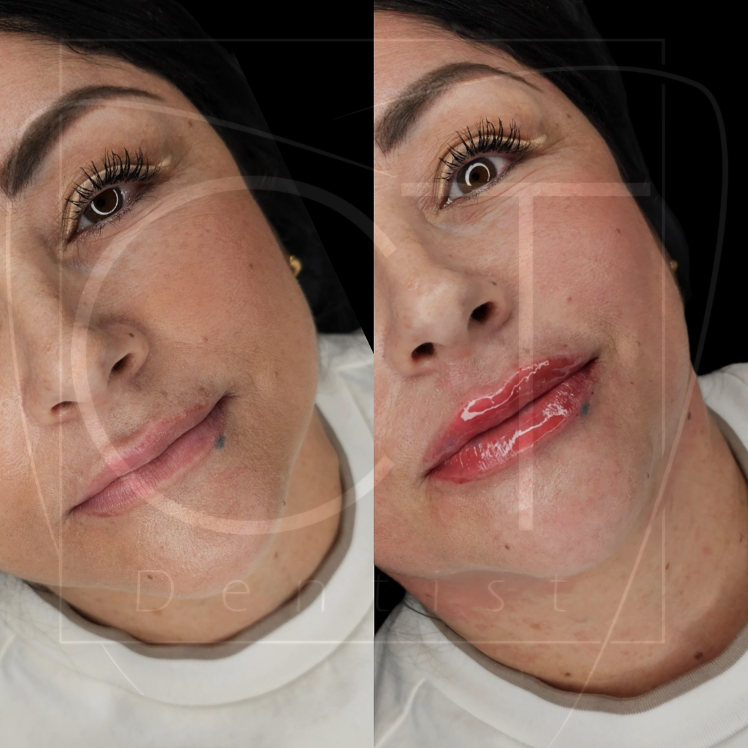 aumento_labios (1)