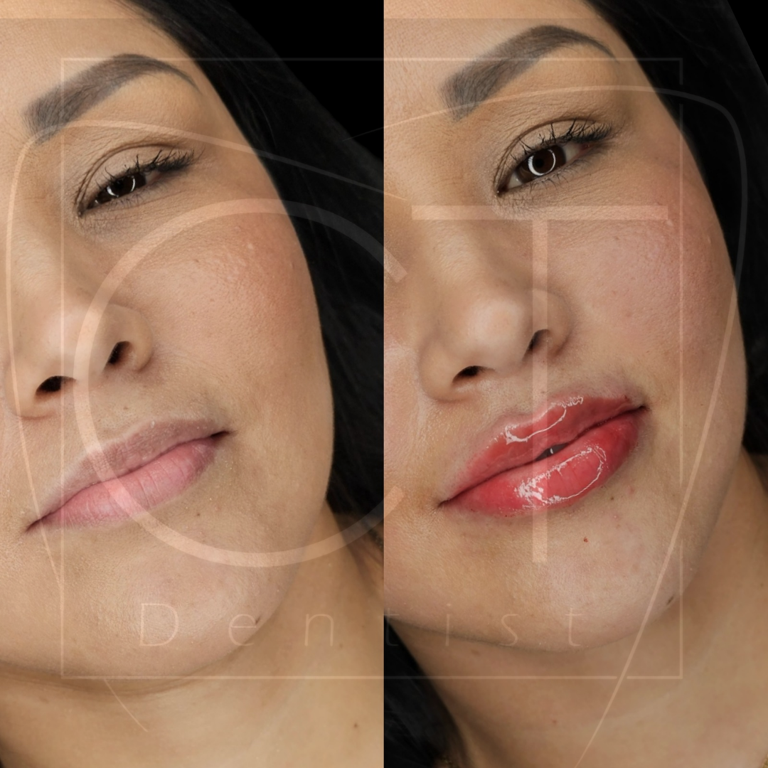 aumento_labios (3)