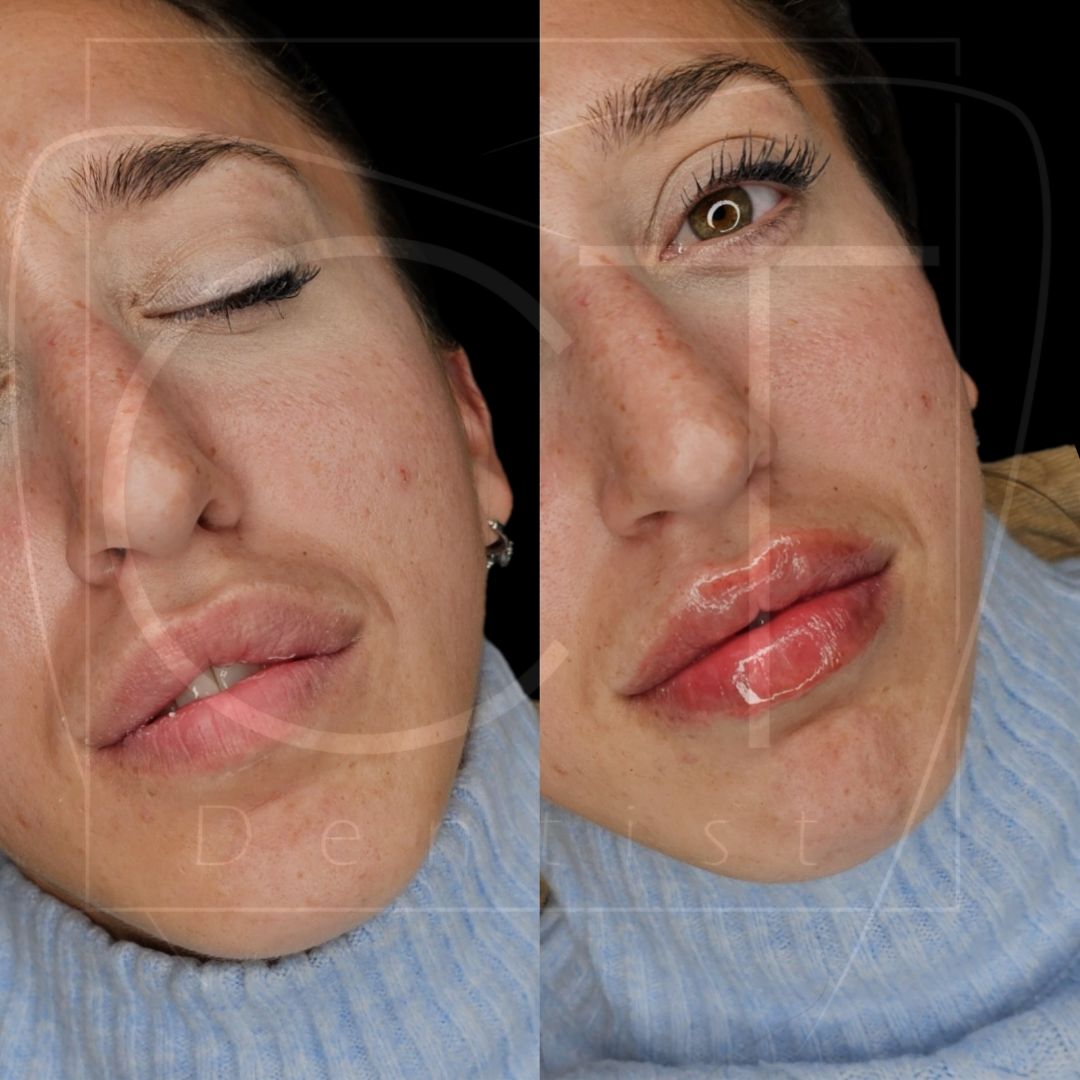 aumento_labios (4)