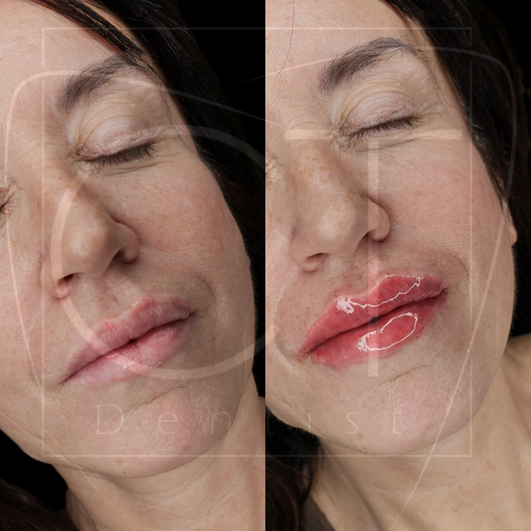 aumento_labios (5)