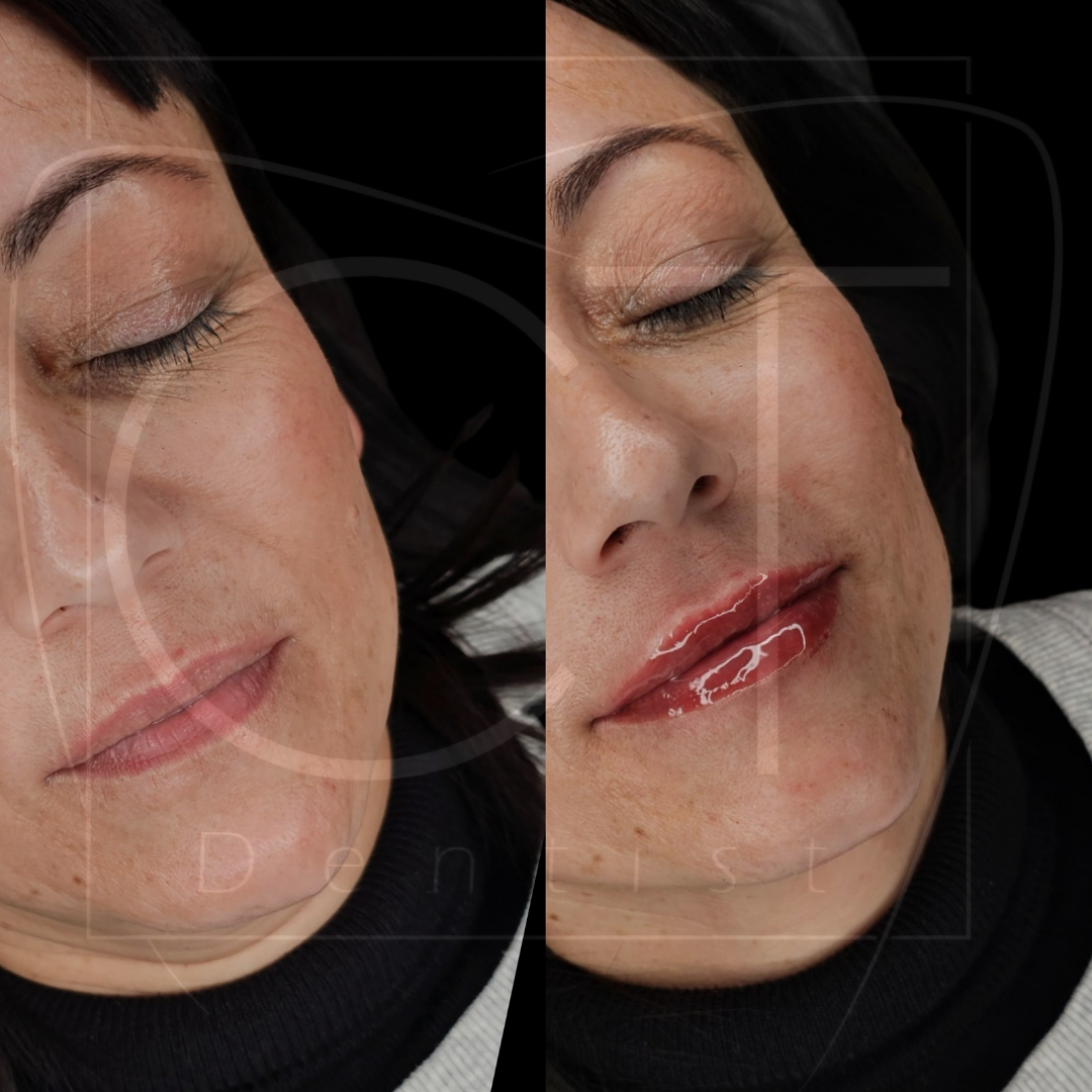 aumento_labios (6)