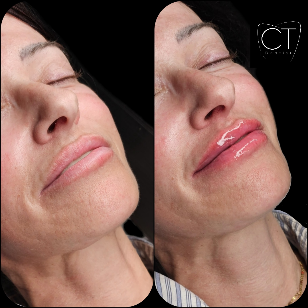 aumento-labios-antes-despues-alcoy-01.jpg