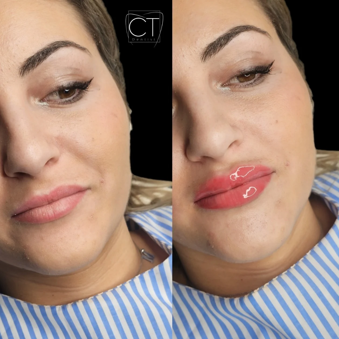 aumento-labios-antes-despues-alcoy-02.jpg