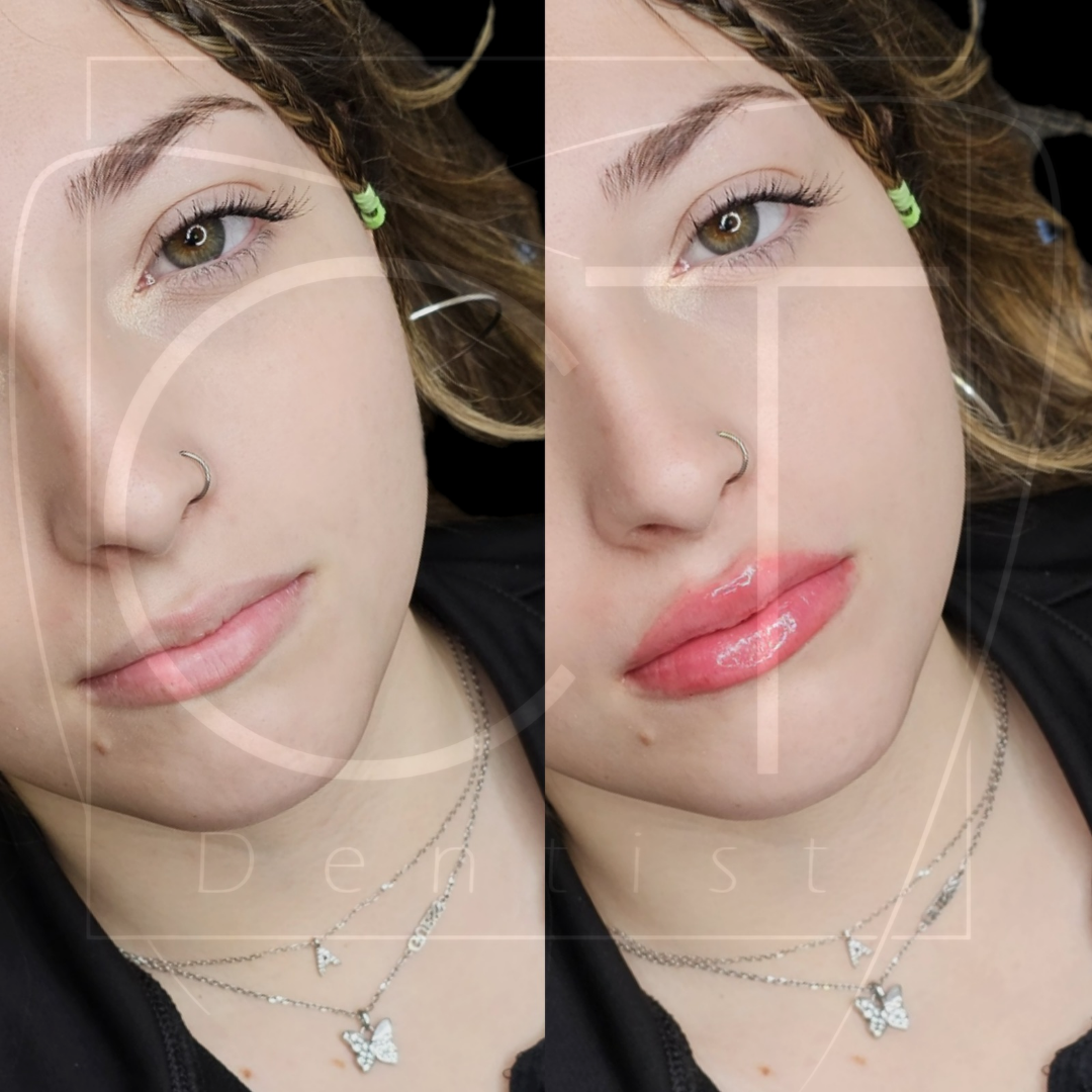 aumento-labios-antes-despues-alcoy-09