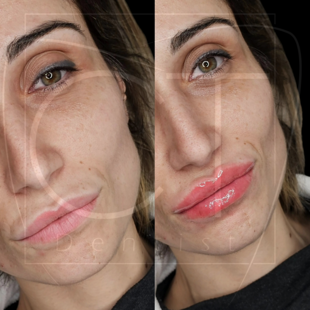 aumento-labios-antes-despues-alcoy-10