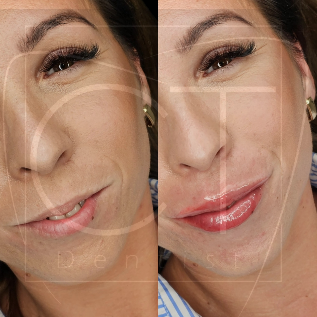 aumento-labios-antes-despues-alcoy-11