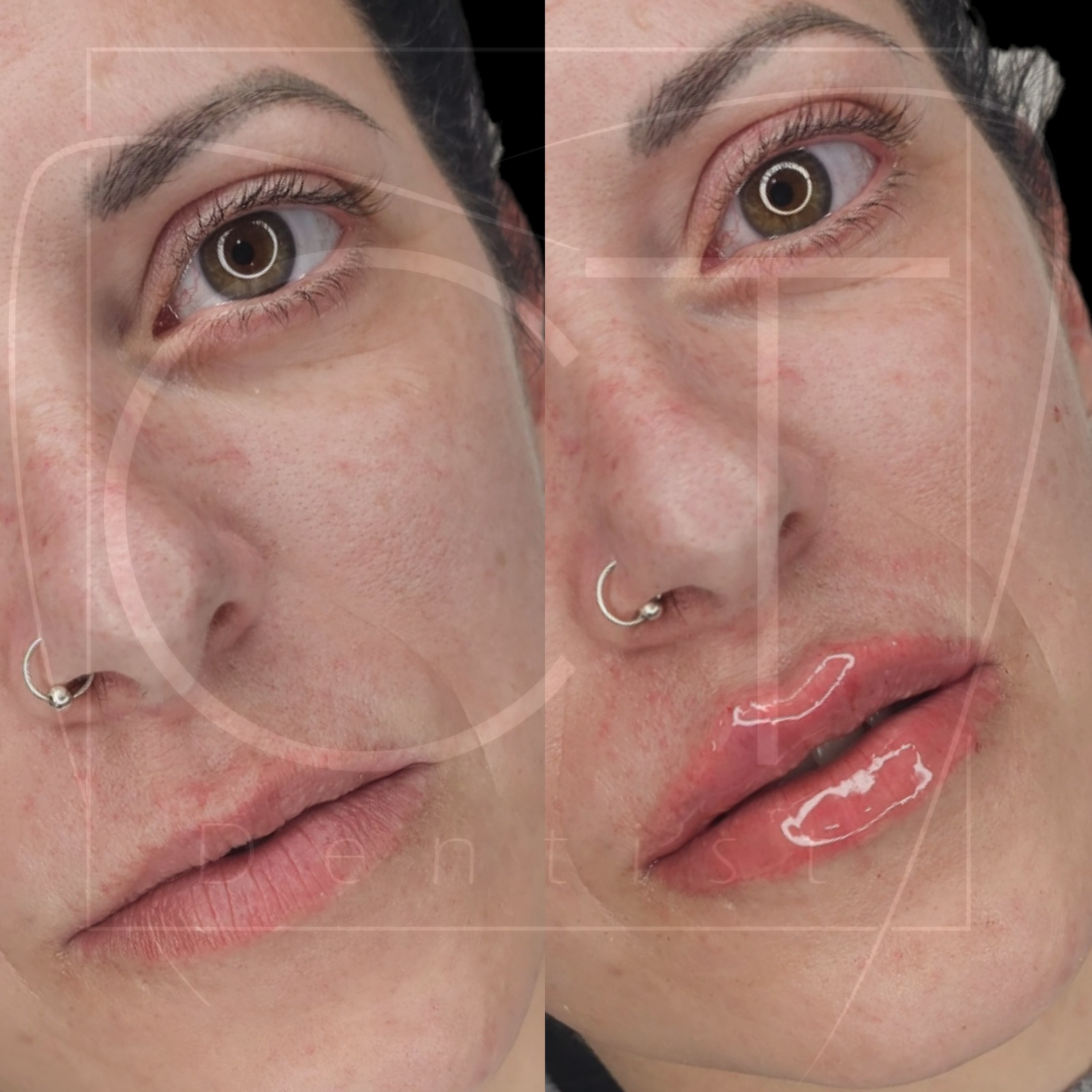 aumento-labios-antes-despues-alcoy-08