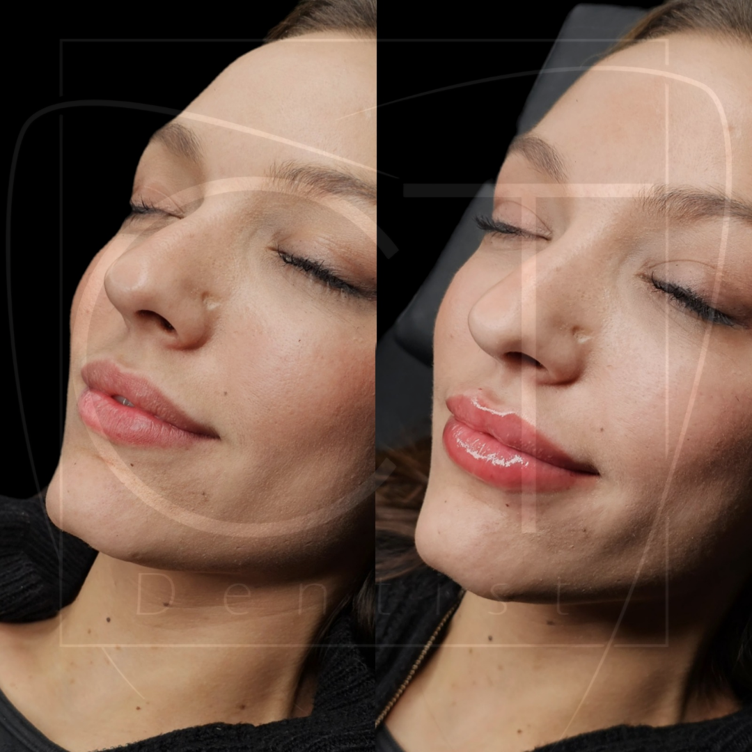 aumento-labios-antes-despues-alcoy-12