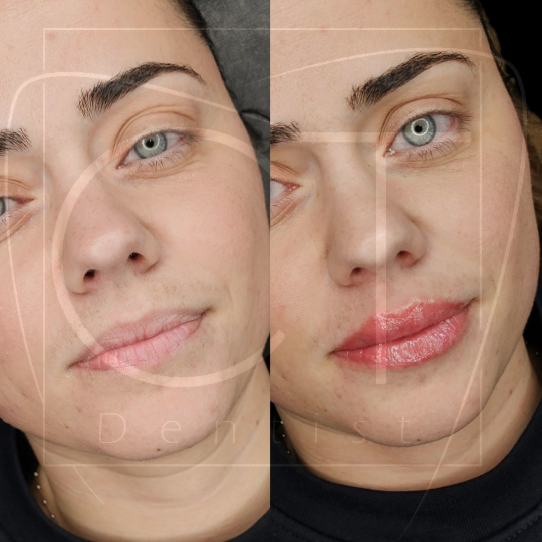 aumento-labios-antes-despues-alcoy-07
