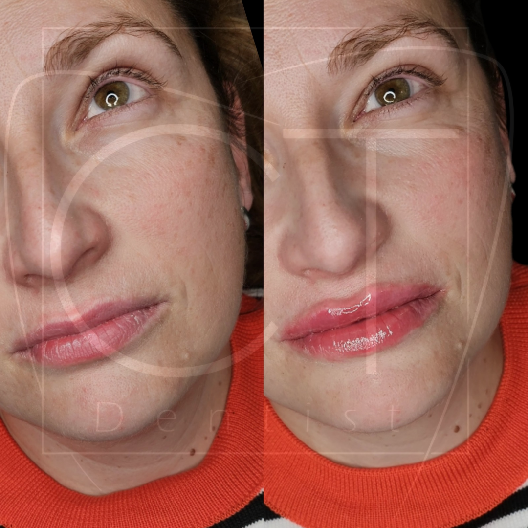 aumento-labios-antes-despues-alcoy-06
