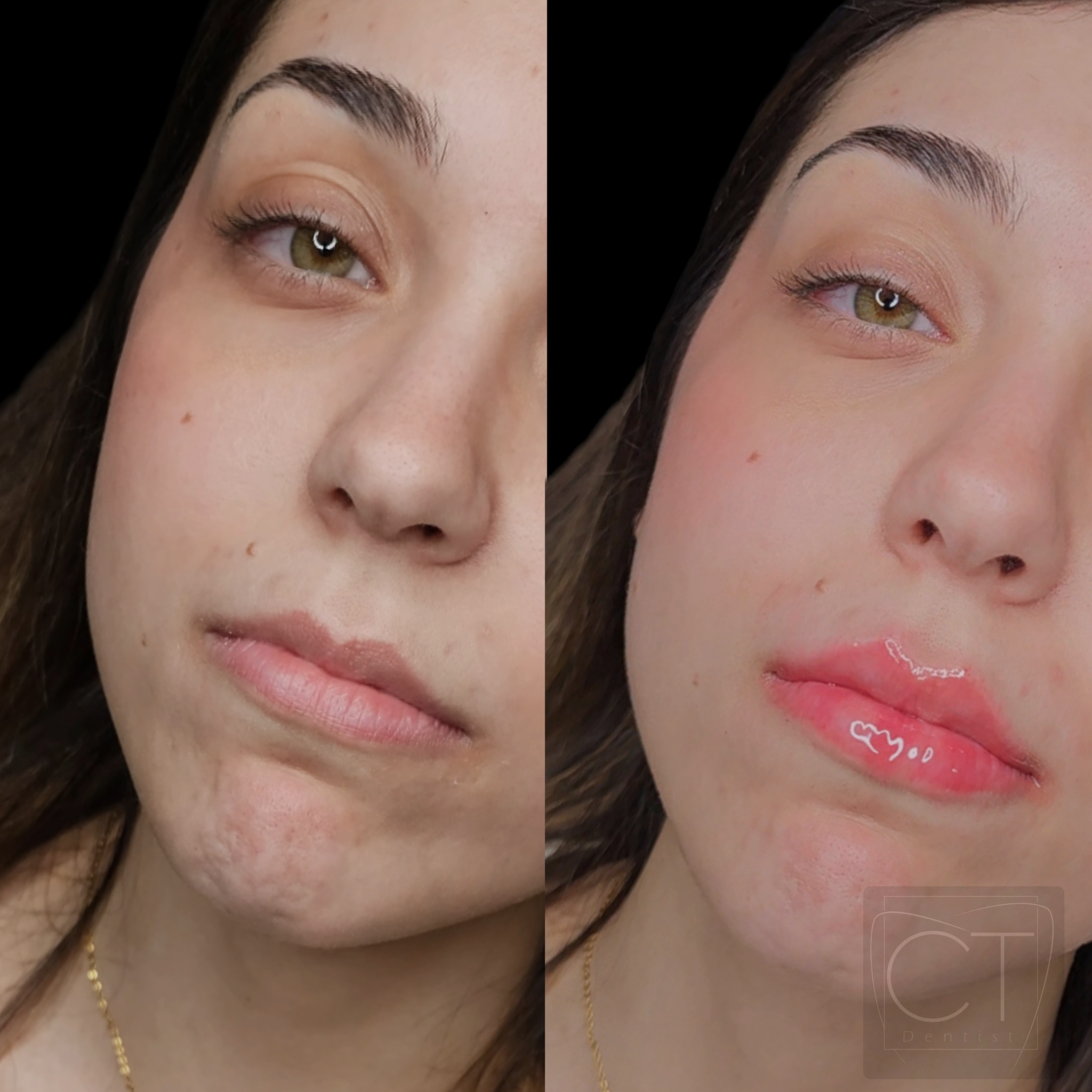 aumento-labios-antes-despues-alcoy-05