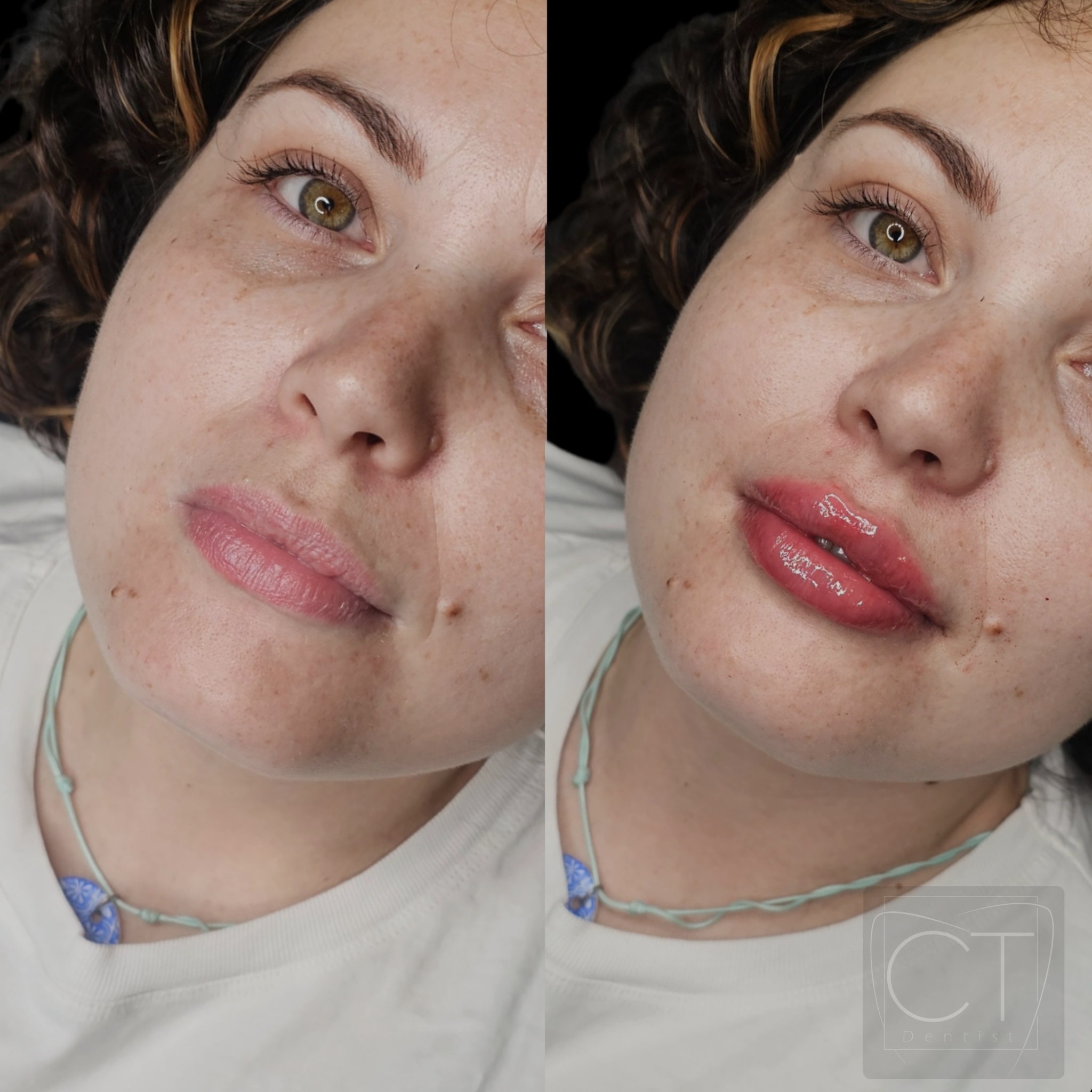 aumento-labios-antes-despues-alcoy-04