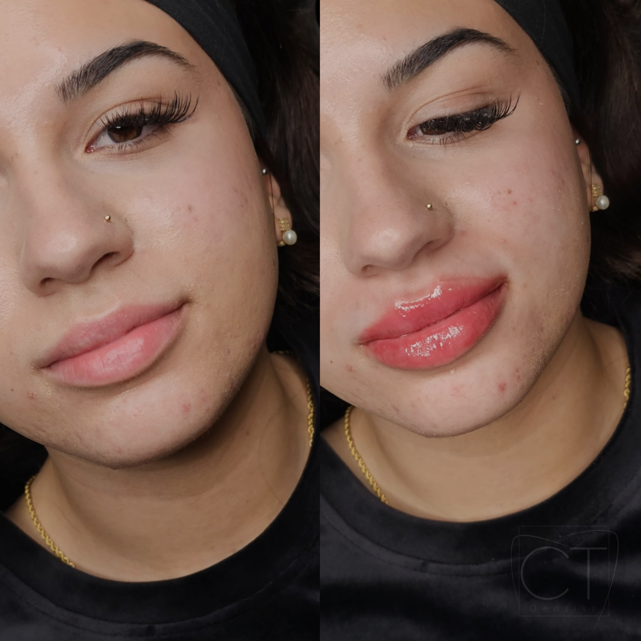 aumento-labios-antes-despues-alcoy-02