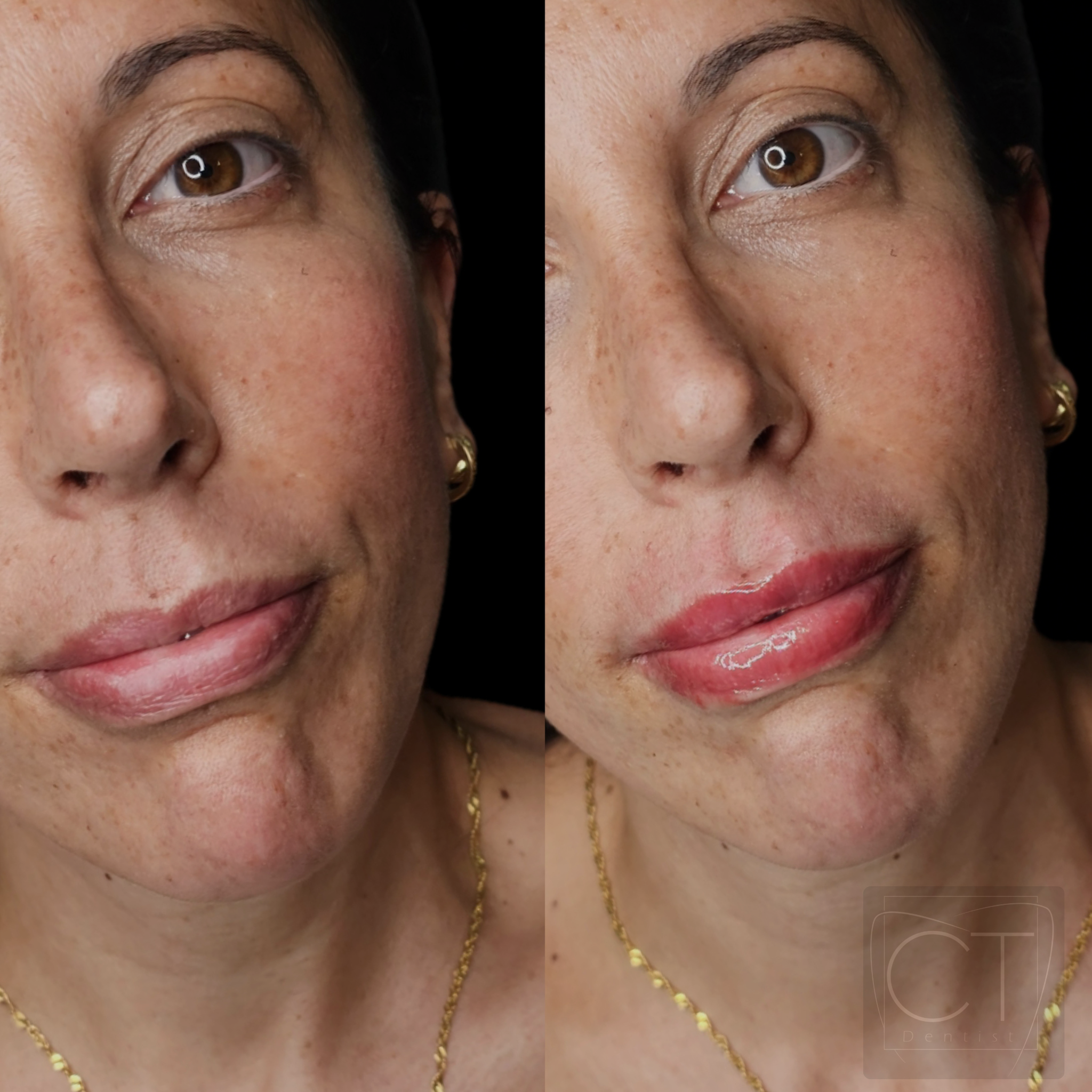 aumento-labios-antes-despues-alcoy-03